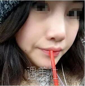 隆鼻尖多久恢复自然?不久前做过隆鼻尖的我有点话想说~
