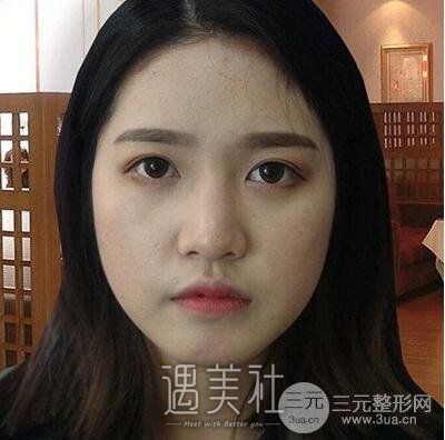 做了鼻头肥大矫正和鼻尖成型，好多男同事来和我搭讪了~