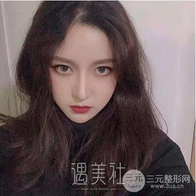 做了鼻头肥大矫正和鼻尖成型，好多男同事来和我搭讪了~