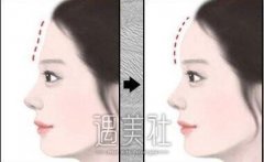 洛阳额部填充大概多少钱?听说有很多种不同的方式呢? width=