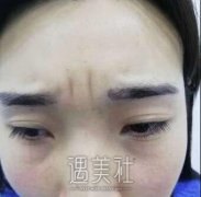 张凯华医生给我做的肉毒毒素除皱，感觉重新回到十八岁~ width=