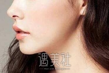 玻尿酸垫下巴