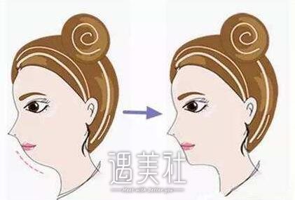 玻尿酸垫下巴