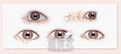 开外眼角前后对比图片昏享：来自一开外眼角真实案例的哇~ width=