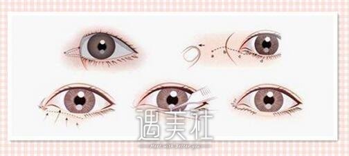 开外眼角前后对比