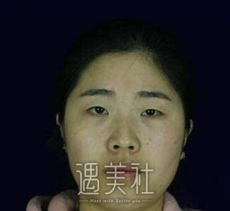 开外眼角前后对比