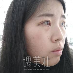 开外眼角前后对比