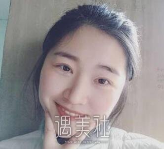 开外眼角前后对比