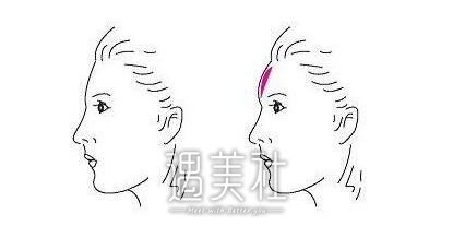 额部填充术