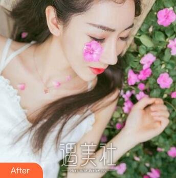 巫文云,隆鼻
