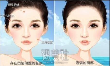 脂肪填充脸