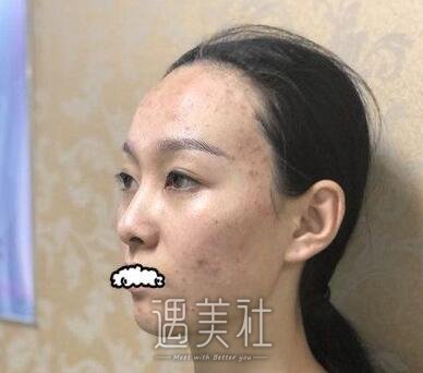 果酸换肤