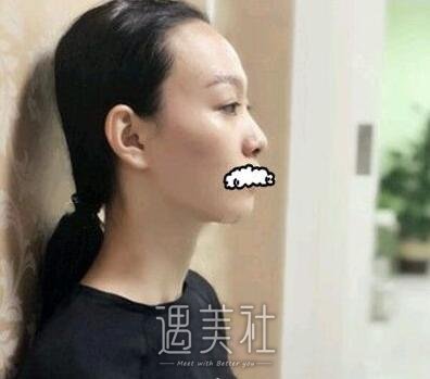 果酸换肤