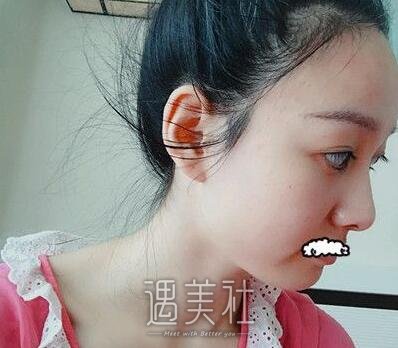 果酸换肤