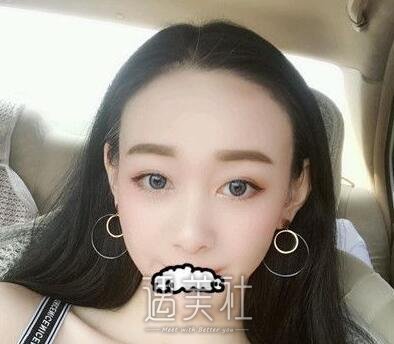 果酸换肤