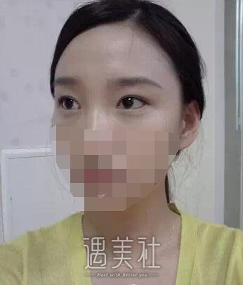 去北京金炫澈整形做了脂肪卧蚕，现在笑起来倍儿魅力哦~