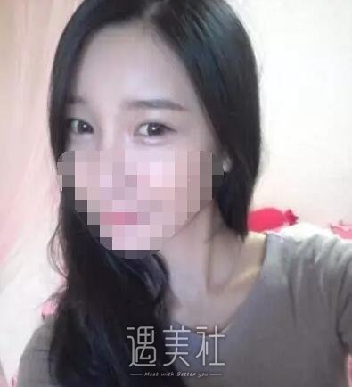去北京金炫澈整形做了脂肪卧蚕，现在笑起来倍儿魅力哦~