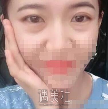 上半年去合肥105医院整形科做了去眼袋，看起来年轻多了～