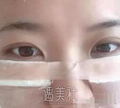 上半年去合肥105医院整形科做了去眼袋，看起来年轻多了～
