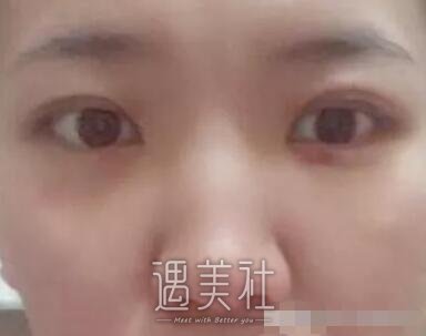 上半年去合肥105医院整形科做了去眼袋，看起来年轻多了～