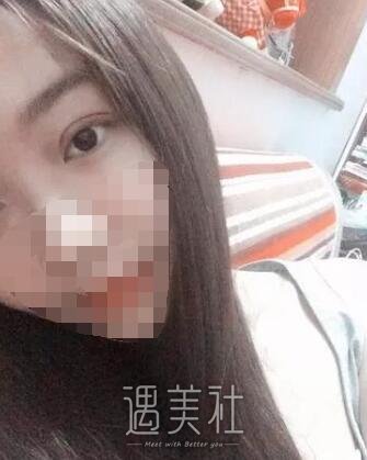 济南伊美尔同时做了割双眼皮和开内眼角，果简直爽翻～