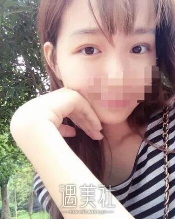 济南伊美尔同时做了割双眼皮和开内眼角，果简直爽翻～