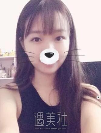 济南伊美尔同时做了割双眼皮和开内眼角，果简直爽翻～