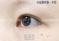 张冰洁医生外眼角修复案例：大小手术都得去正规机构啊～ width=