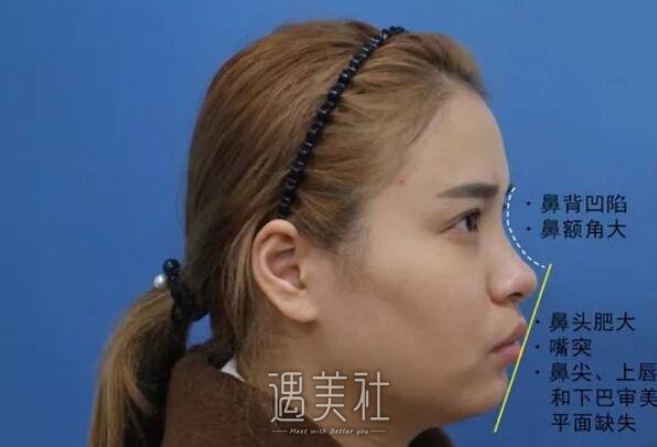 石家庄美联臣做了注射胶原蛋白隆鼻，现在的鼻型很八错～