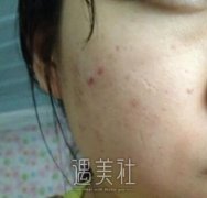 天津维美整形医院治痘怎么样？这条真实案例硬核来证明～ width=