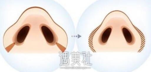 鼻翼大