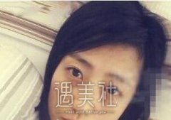 去华山医院整形做了去黑眼圈，这张脸终于不像熊猫脸了～ width=