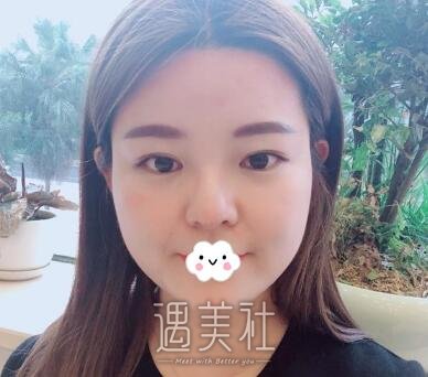 注射瘦脸