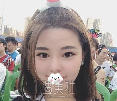 注射瘦脸