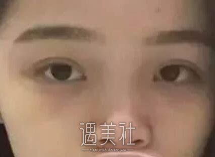短鼻子整形