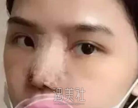 短鼻子整形