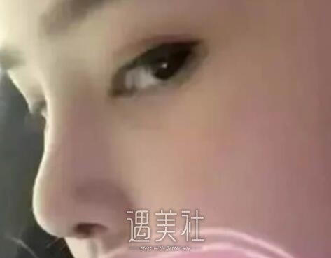 短鼻子整形