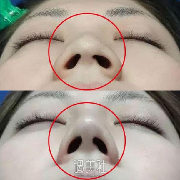 广州做缩鼻翼手术费用大约多少?准备存钱好久去做了~