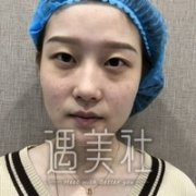 面部光子嫩肤可以除癍吗?脸上太多斑想国庆去做了! width=