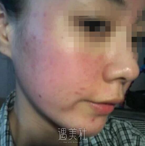 果酸换肤有果吗?刚做果酸换肤不久的我很有发言权~