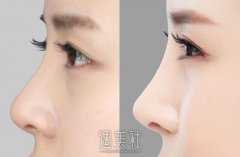 连云港鼻骨整形大约需要多少钱?一起去网上找找资料吧! width=