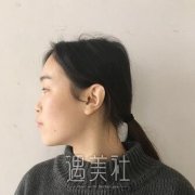 肋骨隆鼻果好不好，有没有案例果图参考了? width=