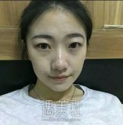 去眼袋专家闫迎军技术怎么样?有近期的去眼袋案例吗? width=
