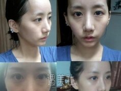 柳州华山整形医院做了去黑眼圈，终于丢掉“熊猫眼”绰号~ width=
