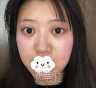 张娇娇割双眼皮怎么样|张娇娇割双眼皮真实案例硬核上线~ width=