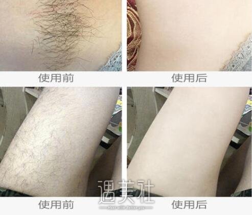 激光脱毛