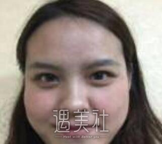 鼻唇沟提升