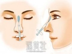 苏州注射胶原蛋白隆鼻大约需要多少钱?很少听说这项目呢～ width=