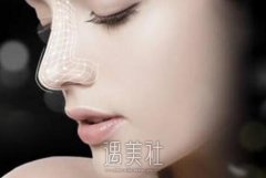 缩鼻翼手术有后遗症吗|缩鼻翼手术几大后遗症快来了解下~ width=