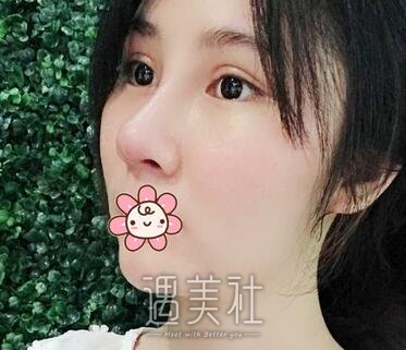 高志丹,隆鼻